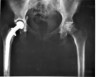 hip xray